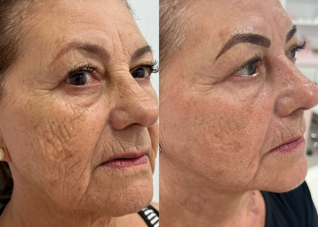 Rejuvenescimento Facial - Antes e Depois
