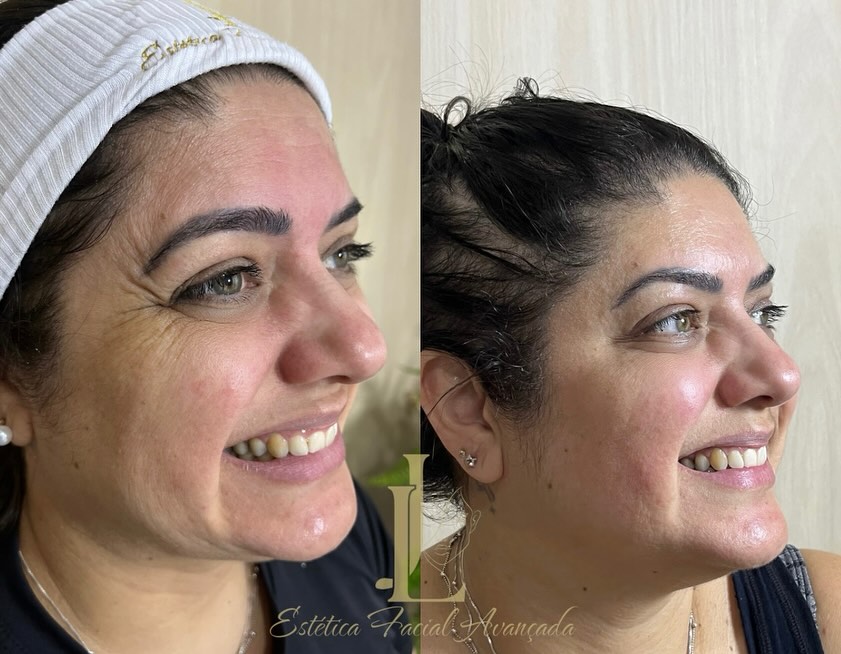 Estética Facial - Antes e Depois