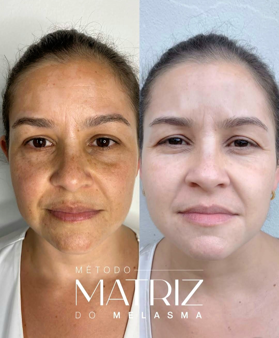 Método Matriz Melasma - Antes e Depois