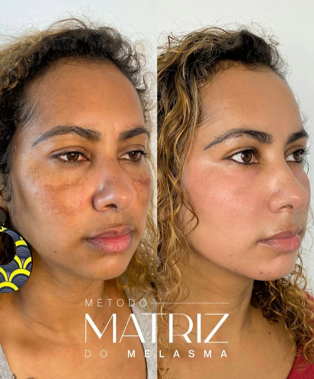 Tratamento de Melasma - Antes e Depois