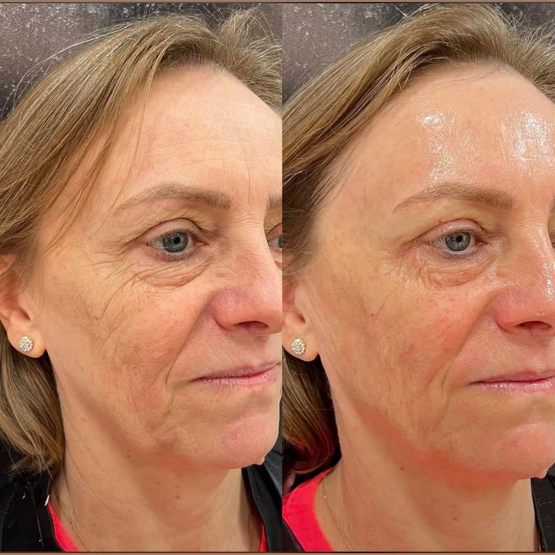 Limpeza de Pele - Antes e Depois