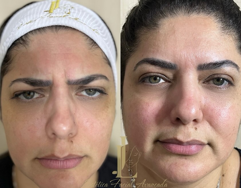Controle de Acne - Antes e Depois